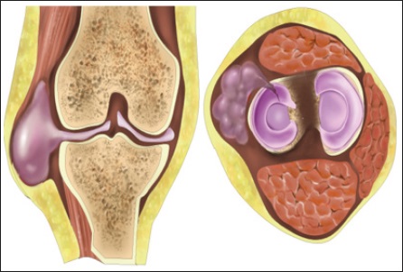 Meniscal Cysts